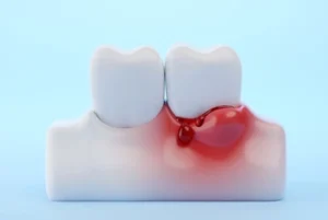 Can You Get Veneers With Gum Disease swelling Can You Get Veneers With Gum Disease swelling