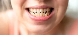patient showing crooked bottom teeth patient showing crooked bottom teeth