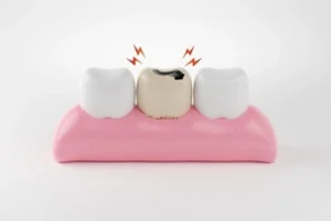 Can Tooth Decay Spread neighbor Can Tooth Decay Spread neighbor