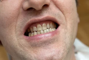 patient showing his decayed teeth patient showing his decayed teeth