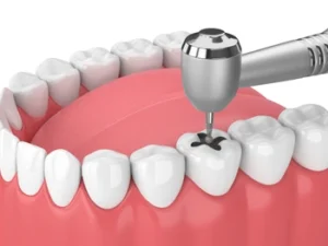 Can Tooth Decay Spread treatment Can Tooth Decay Spread treatment