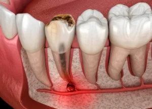 illustration of a Tiny Black Spot on Tooth illustration of a Tiny Black Spot on Tooth