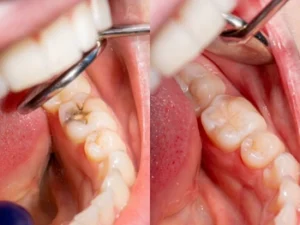what Causes Tooth Decay what Causes Tooth Decay