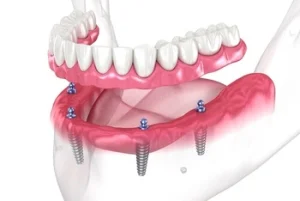 full lower arch dental implant restoration
