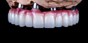full upper arch dental implant restoration
