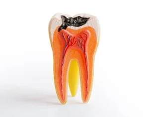 broken tooth exposed pulp root broken tooth exposed pulp root