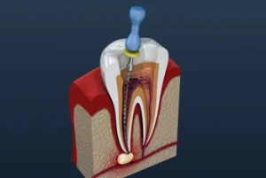 during root canal procedure during root canal procedure